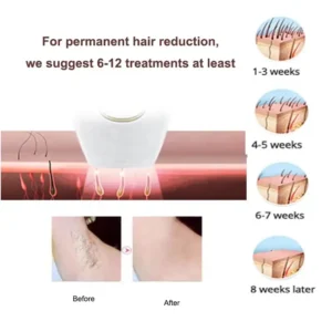 IPL Hair remover results